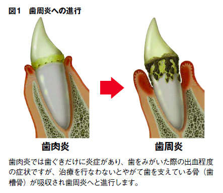 歯周病への進行